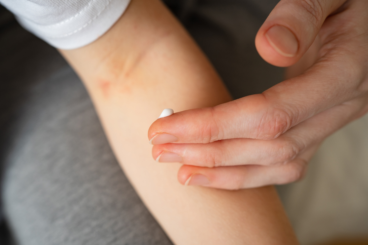 Elbow eczema: symptoms, treatments