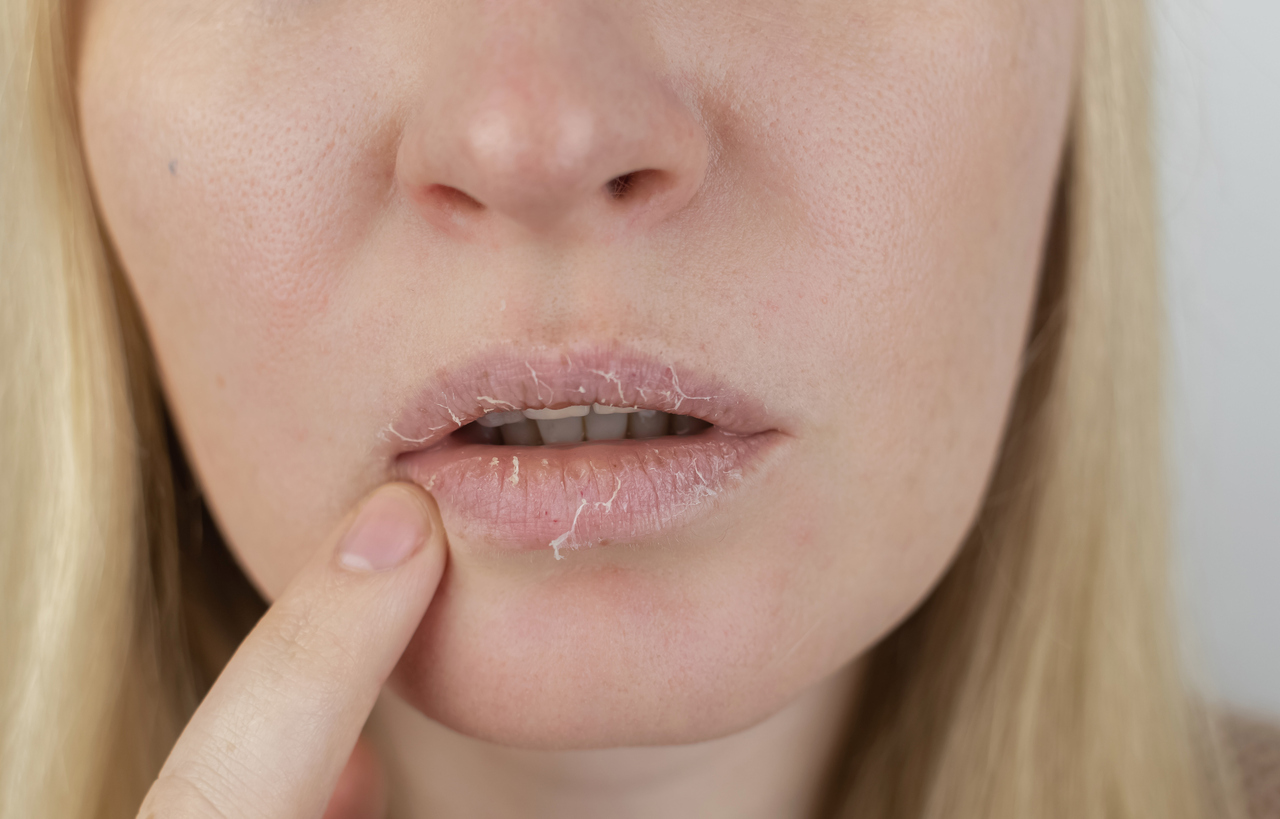 Eczema of the mouth and lips: causes and treatments