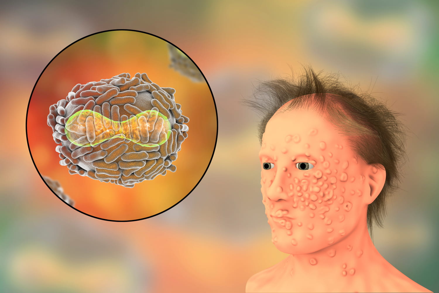 Smallpox: symptoms, vaccine, photo, no treatment?