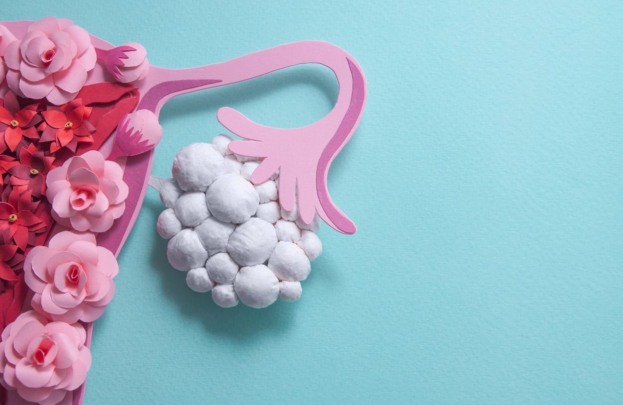 What is PCOS, the leading cause of female infertility?  – She